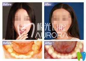 模特尋成都極光口腔醫(yī)生為牙齒矯正 不露痕跡重燃微笑