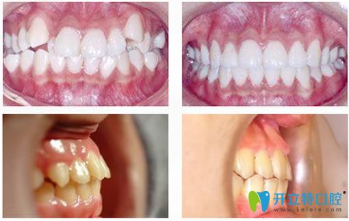 南京雅康口腔牙齒矯正案例 南京雅康口腔牙齒矯正案例