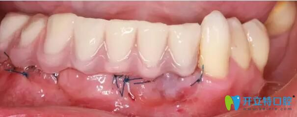 南通摩爾口腔牙齒種植后