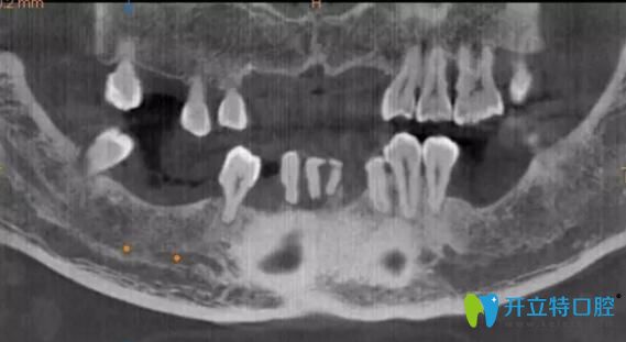 牙齒缺失怎么辦？看看南通摩爾口腔數(shù)字化種植牙你就知道