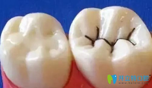 窩溝封閉對(duì)比圖