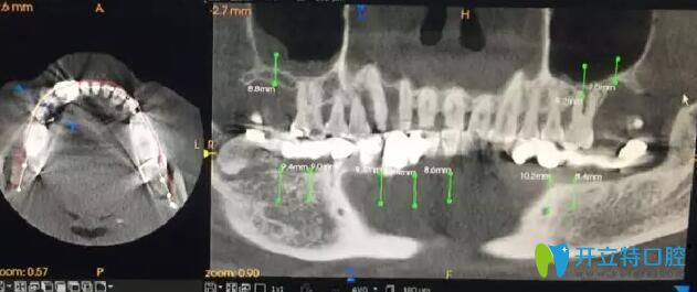 南通摩爾口腔術(shù)前手術(shù)設計