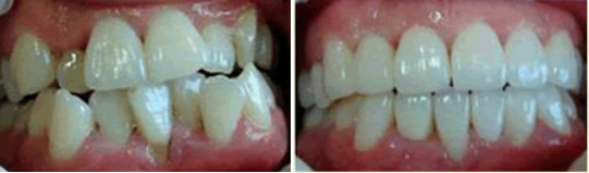 杭州美奧口腔三個(gè)月前 牙齒擁擠的我找杭州美奧王明做了隱形牙齒矯正
