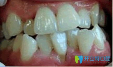 杭州美奧口腔牙齒矯正前的我 杭州美奧口腔牙齒矯正前的我