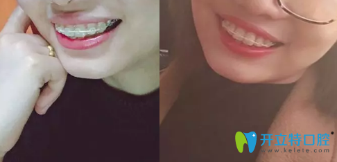 陳炳霖做牙齒矯正后兩個(gè)月的照片