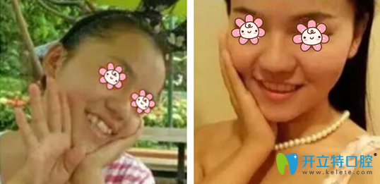 牙齒矯正的好處有哪些，一般矯正牙齒多少錢？