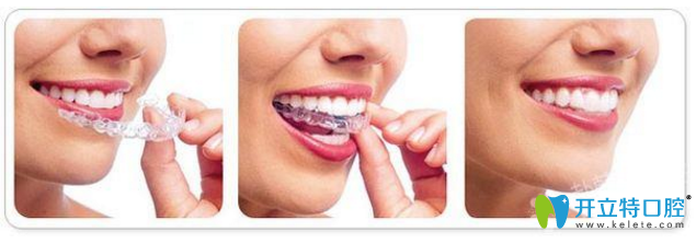 隱形矯正是如何進(jìn)行的?