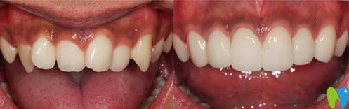 廣州圣貝口腔隱形牙齒矯正案例