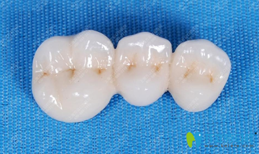 東莞美立方烤瓷牙