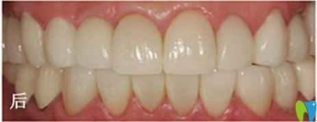 在南京雅康做全瓷貼面美牙效果