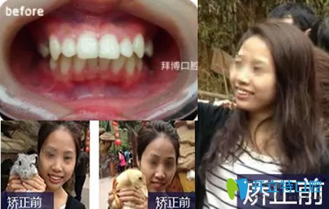 無(wú)錫拜博口腔陳炳霖做牙齒矯正美白前照片