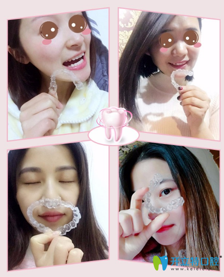 廣州圣貝口腔時(shí)代天使隱形矯正案例