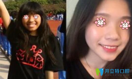 趙越主任牙齒矯正案例