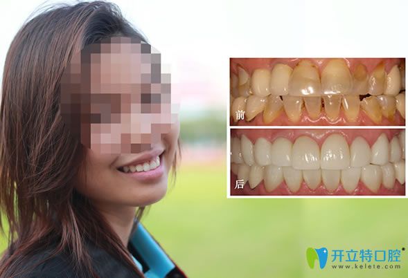 南京雅康口腔德國3D超薄全瓷牙貼面幫我成功擺脫了四環(huán)素牙