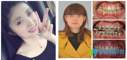 廣州圣貝口腔3M金屬托槽牙齒矯正案例