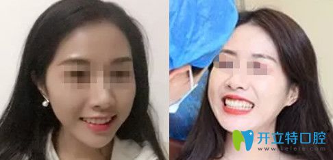 無(wú)錫拜博口腔牙齒矯正一年效果圖