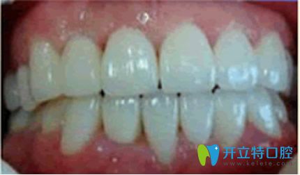杭州美奧牙齒矯正三個(gè)月效果案例 杭州美奧牙齒矯正三個(gè)月效果案例