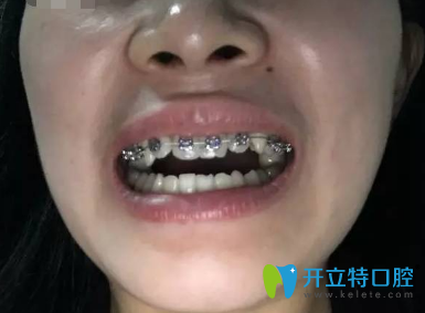 大家看看我去西安蓮湖圣貝口腔門(mén)診部做的地包天牙齒矯正