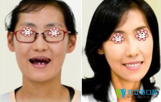 楊靜巖醫(yī)師種植牙案例 楊靜巖醫(yī)師種植牙案例