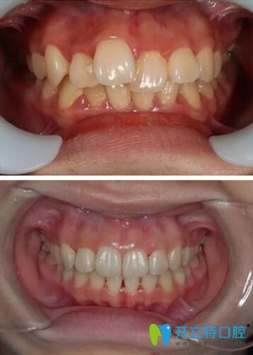 段嬌紅牙齒矯正案例 段嬌紅牙齒矯正案例