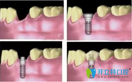 ITI種植材料采用四級純鈦材料