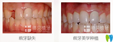 牙缺失種植牙前后對(duì)比效果