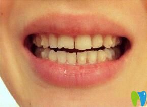 牙齒矯正五個(gè)月后效果