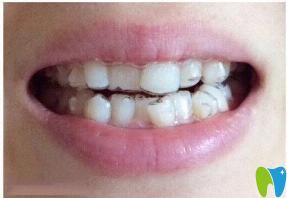 感謝昆明柏德口腔 讓我在短短五個月內(nèi)改變參差不齊的牙齒