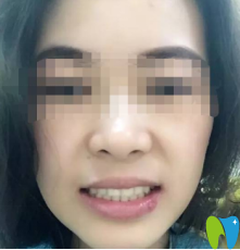 牙齒完全恢復好的樣子