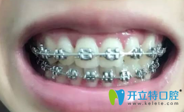 一個月后牙齒樣子