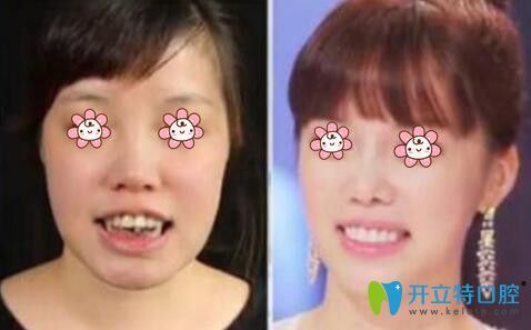 牙齒矯正后悔一輩子真相揭秘