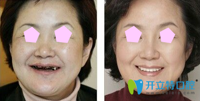 寧波牙博士口腔張春旭即刻種植牙案例效果圖