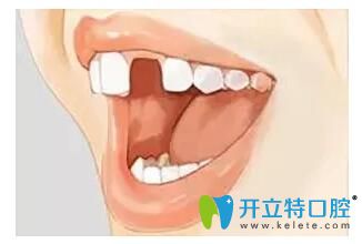 如果缺少了一顆牙 是選擇種植牙好還是烤瓷牙好呢？