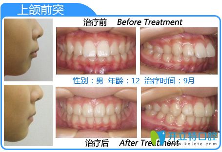 隱形正畸前后對比案例 隱形正畸前后對比案例