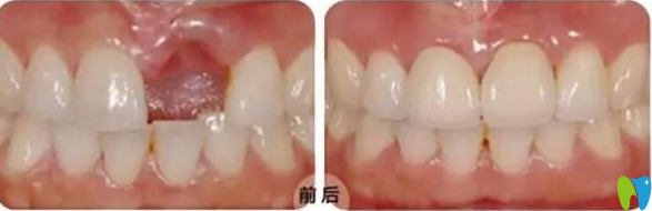 種植牙前后