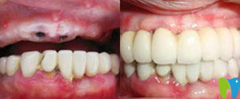 寧波牙博士口腔金勇和醫(yī)生種植牙效果對比圖