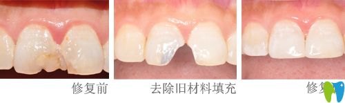 楊瑾瑛醫(yī)生做牙齒修復(fù)案例