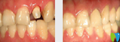 寧波牙博士口腔<!--<i data=20240703-sp></i>-->陽(yáng)根管治療效果對(duì)比圖