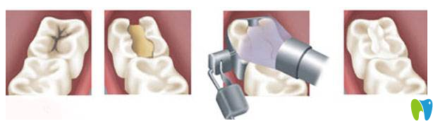 微創(chuàng)補牙