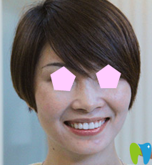 我在寧波牙博士做仿生美牙冠矯正后的樣子