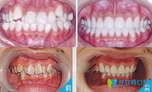 重慶牙博士口腔劉永貴院長牙齒矯正案例對(duì)比圖