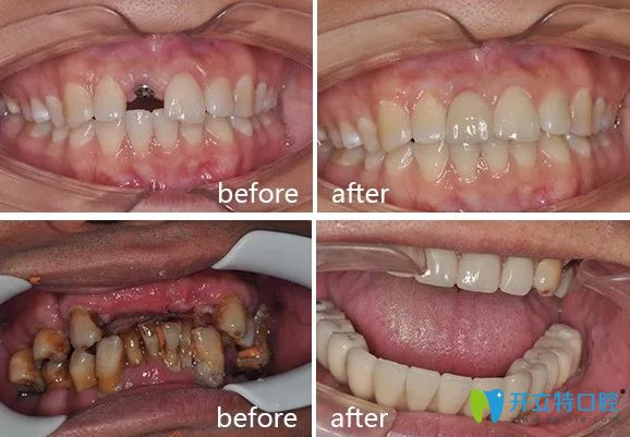 重慶牙博士阿爾弗雷多·羅薩蒂種植牙案例前后對(duì)比圖