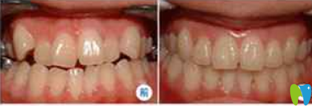 我牙齒稀疏牙縫大 在福州美可普口腔做牙齒矯正時沒帶牙套