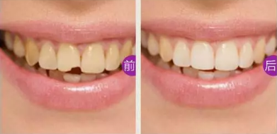 門(mén)牙缺損怎么辦？看湛江珠江口腔做嵌體修復(fù)后真假牙難辨