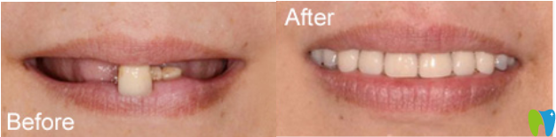 洛陽(yáng)牙齒矯正案例效果