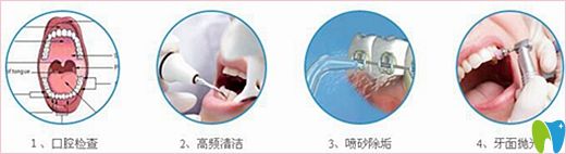 揚(yáng)洲菲特口腔超聲波潔牙過程