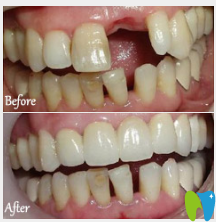 廣州暨博口腔薛國初牙齒種植案例對比圖