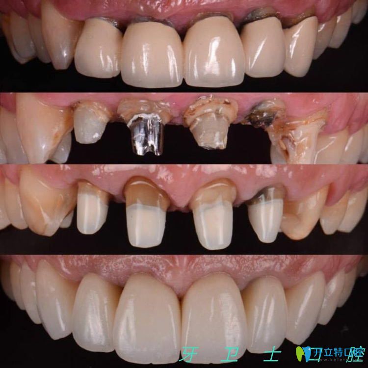 種植牙前后對(duì)比案例