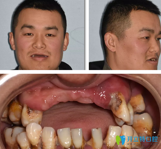 男子在重慶牙博士做即刻種植牙案例：術(shù)后即刻當眾吃蘋果