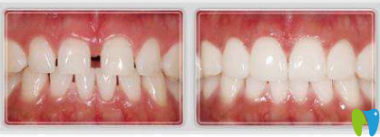 口腔牙齒磨損修復(fù)